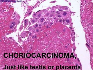 CHORIOCARCINOMA, 
Just like testis or placenta 
 