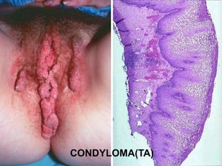 CONDYLOMA(TA) 
 