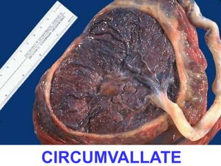 CIRCUMVALLATE 
 