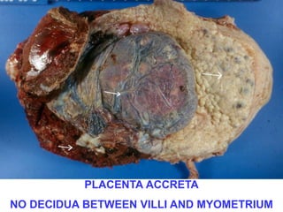 PLACENTA ACCRETA 
NO DECIDUA BETWEEN VILLI AND MYOMETRIUM 
 