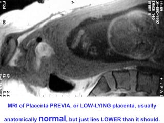 MRI of Placenta PREVIA, or LOW-LYING placenta, usually 
anatomically normal, but just lies LOWER than it should. 
 