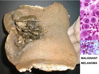 MALIGNANT 
MELANOMA 
 