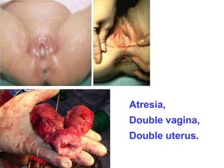 Atresia, 
Double vagina, 
Double uterus. 
 