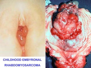 CHILDHOOD EMBYRONAL 
RHABDOMYOSARCOMA 
 