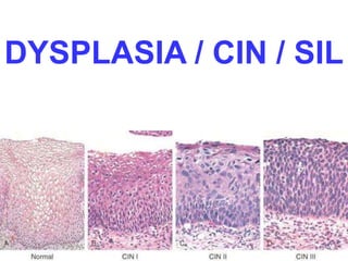 DYSPLASIA / CIN / SIL 
 