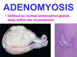 ADENOMYOSIS 
• Defined as normal endometrial glands 
deep within the myometrium 
 