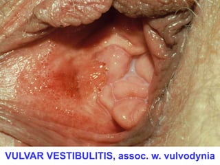 VULVAR VESTIBULITIS, assoc. w. vulvodynia 
 
