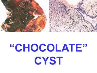 “CHOCOLATE” 
CYST 
 