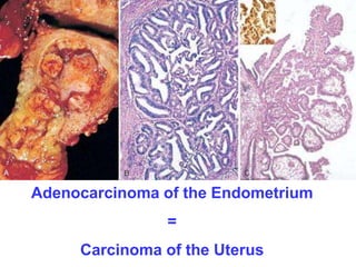 Adenocarcinoma of the Endometrium 
= 
Carcinoma of the Uterus 
 