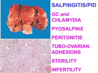 SALPINGITIS/PID 
GC and 
CHLAMYDIA 
PYOSALPINX 
PERITONITIS 
TUBO-OVARIAN 
ADHESIONS 
STERILITY 
INFERTILITY 
 