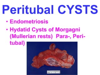 Peritubal CYSTS 
• Endometriosis 
• Hydatid Cysts of Morgagni 
(Mullerian rests) Para-, Peri-tubal) 
 