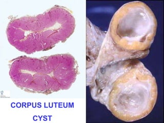 CORPUS LUTEUM 
CYST 
 
