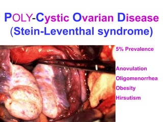POLY-Cystic Ovarian Disease 
(Stein-Leventhal syndrome) 
5% Prevalence 
Anovulation 
Oligomenorrhea 
Obesity 
Hirsutism 
 
