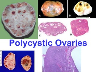 Polycystic Ovaries 
 
