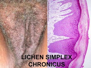 LICHEN SIMPLEX 
CHRONICUS 
 