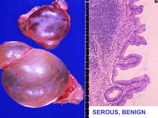 SEROUS, BENIGN 
 