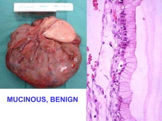 MUCINOUS, BENIGN 
 