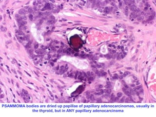 PSAMMOMA bodies are dried up papillae of papillary adenocarcinomas, usually in 
the thyroid, but in ANY papillary adenocarcinoma 
 