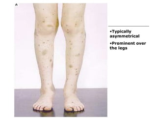 Typically asymmetrical Prominent over the legs 