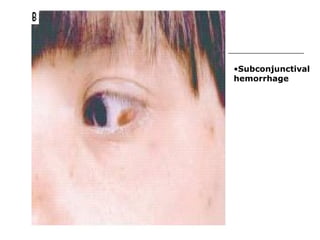 Subconjunctival hemorrhage 