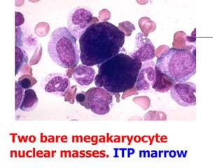 Two bare megakaryocyte nuclear masses.  ITP marrow 