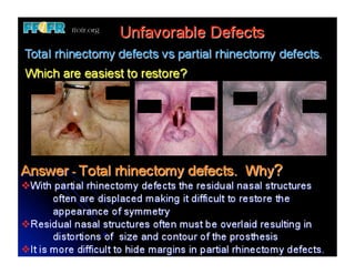 23.restoration of nasal defects | PDF