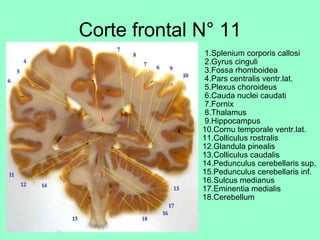 Corte frontal N° 11   1.Splenium corporis callosi  2.Gyrus cinguli  3.Fossa rhomboidea  4.Pars centralis ventr.lat.  5.Plexus choroideus  6.Cauda nuclei caudati  7.Fornix  8.Thalamus  9.Hippocampus 10.Cornu temporale ventr.lat. 11.Colliculus rostralis 12.Glandula pinealis 13.Colliculus caudalis 14.Pedunculus cerebellaris sup. 15.Pedunculus cerebellaris inf. 16.Sulcus medianus 17.Eminentia medialis 18.Cerebellum  