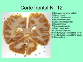 Corte frontal N° 12   1.Splenium corporis callosi  2.Gyrus cinguli  3.Ventriculus lateralis  4.Plexus choroideus  5.Cauda nuclei caudati  6.Hippocampus  7.Sulcus collateralis  8.Glandula pinealis  9.Colliculus caudalis 10.Pedunculus cerebellaris rostr. 11.Pedunculus cerebellaris caud. 12.Cerebellum 
