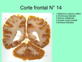 Corte frontal N° 14   1.Splenium corporis callosi  2.Ventriculus lateralis  3.Sulcus collateralis  4.Cauda nuclei caudati  5.Nucleus dentatus 