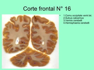 Corte frontal N° 16   1.Cornu occipitale ventr.lat.  2.Sulcus calcarinus  3.Vermis cerebelli  4.Hemisphaeria cerebelli 