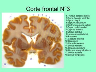 Corte frontal N°3   1.Truncus corporis callosi  2.Cornu frontale ventr.lat.  3.Gyrus cinguli  4.Septum pellucidum  5.Rostrum corporis callosi  6.Caput nuclei caudati  7.Capsula interna  8.Globus pallidus  9.Lamina medullaris lat. 10.Putamen 11.Capsula externa 12.Claustrum 13.Capsula extrema 14.Lobus insularis 15.Chiasma opticum 16.Corpus amygdaloideum 17.Lobus frontalis 18.Lobus temporalis 
