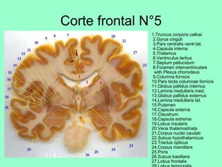 Corte frontal N°5 1.Truncus corporis callosi  2.Gyrus cinguli  3.Pars centralis ventr.lat.  4.Capsula interna  5.Thalamus  6.Ventriculus tertius  7.Septum pellucidum  8.Foramen interventriculare   with Plexus choroideus  9.Columna fornicis 10.Pars tecta columnae fornicis 11.Globus pallidus internus 12.Lamina medullaris med. 13.Globus pallidus externus 14.Lamina medullaris lat. 15.Putamen 16.Capsula externa 17.Claustrum 18.Capsula extrema 19.Lobus insularis 20.Vena thalamostriata 21.Corpus nuclei caudati 22.Sulcus hypothalamicus 23.Tractus opticus 24.Corpus mamillare 25.Pons 26.Sulcus basillaris 27.Lobus frontalis 28.Lobus temporalis 