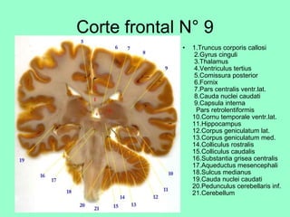 Corte frontal N° 9 1.Truncus corporis callosi  2.Gyrus cinguli  3.Thalamus  4.Ventriculus tertius  5.Comissura posterior  6.Fornix  7.Pars centralis ventr.lat.  8.Cauda nuclei caudati  9.Capsula interna   Pars retrolentiformis 10.Cornu temporale ventr.lat. 11.Hippocampus 12.Corpus geniculatum lat. 13.Corpus geniculatum med. 14.Colliculus rostralis 15.Colliculus caudalis 16.Substantia grisea centralis 17.Aqueductus mesencephali 18.Sulcus medianus 19.Cauda nuclei caudati 20.Pedunculus cerebellaris inf. 21.Cerebellum  