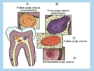 Pulp Stones Histology Diagram