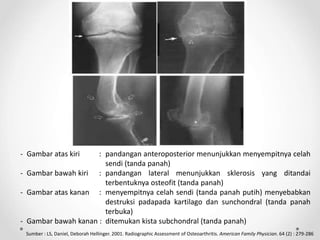 - Gambar atas kiri : pandangan anteroposterior menunjukkan menyempitnya celah
sendi (tanda panah)
- Gambar bawah kiri : pandangan lateral menunjukkan sklerosis yang ditandai
terbentuknya osteofit (tanda panah)
- Gambar atas kanan : menyempitnya celah sendi (tanda panah putih) menyebabkan
destruksi padapada kartilago dan sunchondral (tanda panah
terbuka)
- Gambar bawah kanan : ditemukan kista subchondral (tanda panah)
Sumber : LS, Daniel, Deborah Hellinger. 2001. Radiographic Assessment of Osteoarthritis. American Family Physician. 64 (2) : 279-286
 