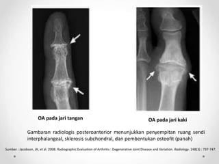 OA pada jari tangan OA pada jari kaki
Gambaran radiologis posteroanterior menunjukkan penyempitan ruang sendi
interphalangeal, sklerosis subchondral, dan pembentukan osteofit (panah)
Sumber : Jacobson, JA, et al. 2008. Radiographic Evaluation of Arthritis : Degenerative Joint Disease and Variation. Radiology. 248(3) : 737-747.
 