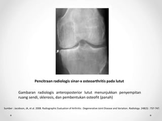 Pencitraan radiologis sinar-x osteoarthritis pada lutut
Gambaran radiologis anteroposterior lutut menunjukkan penyempitan
ruang sendi, sklerosis, dan pembentukan osteofit (panah)
Sumber : Jacobson, JA, et al. 2008. Radiographic Evaluation of Arthritis : Degenerative Joint Disease and Variation. Radiology. 248(3) : 737-747.
 