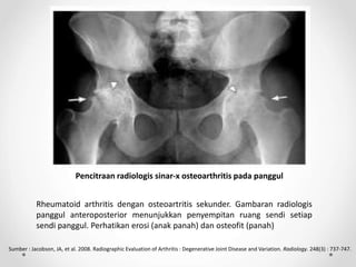 Pencitraan radiologis sinar-x osteoarthritis pada panggul
Rheumatoid arthritis dengan osteoartritis sekunder. Gambaran radiologis
panggul anteroposterior menunjukkan penyempitan ruang sendi setiap
sendi panggul. Perhatikan erosi (anak panah) dan osteofit (panah)
Sumber : Jacobson, JA, et al. 2008. Radiographic Evaluation of Arthritis : Degenerative Joint Disease and Variation. Radiology. 248(3) : 737-747.
 
