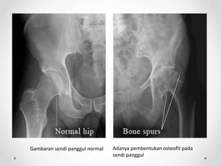 Gambaran sendi panggul normal Adanya pembentukan osteofit pada
sendi panggul
 