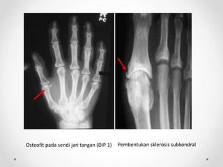 Osteofit pada sendi jari tangan (DIP 1) Pembentukan sklerosis subkondral
 