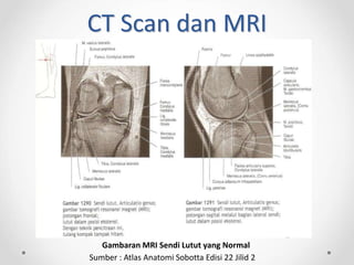 CT Scan dan MRI
Gambaran MRI Sendi Lutut yang Normal
Sumber : Atlas Anatomi Sobotta Edisi 22 Jilid 2
 