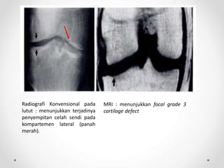 Radiografi Konvensional pada
lutut : menunjukkan terjadinya
penyempitan celah sendi pada
kompartemen lateral (panah
merah).
MRI : menunjukkan focal grade 3
cartilage defect
 