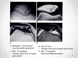 A. Radiografi Konvensional :
(sunrise pateilar projection)
B. Axial CT Scan :
Terdapat kista kecil di bagian apex patela
C. MRI : T1 weighted
Terdapat kista kecil di bagian
apex patella
D. MRI : T2 weighted
Terjadi cartilage denudation
 