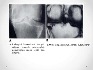 A. Radiografi Konvensional : tampak
adanya sclerosis subchondral,
penyempitan ruang sendi, dan
osteofit
B. MRI : tampak adanya sclerosis subchondral
 