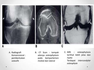 A. Radiografi
Konvensional :
pembentukan
osteofit
B. CT Scan : tampak
adanya osteophytosis
pada kompartemen
medial dan lateral
C. MRI : osteophytosis
terlihat lebih jelas dan
nyata
Terdapat intercondylar
osteophyte
 