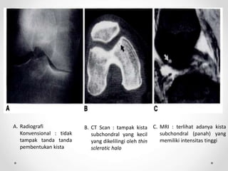 A. Radiografi
Konvensional : tidak
tampak tanda tanda
pembentukan kista
B. CT Scan : tampak kista
subchondral yang kecil
yang dikelilingi oleh thin
sclerotic halo
C. MRI : terlihat adanya kista
subchondral (panah) yang
memiliki intensitas tinggi
 
