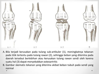 A. Bila terjadi kerusakan pada tulang sub-artikuler (1), meningkatnya tekanan
pada titik tertentu pada tulang rawan (2), sehingga beban yang diterima pada
daerah tersebut berlebihan atau kerusakan tulang rawan sendi oleh karena
suatu hal (3) dapat menyebabkan osteoartritis
B. Gambar skematis tekanan yang diterima akibat beban tubuh pada sendi yang
normal
 