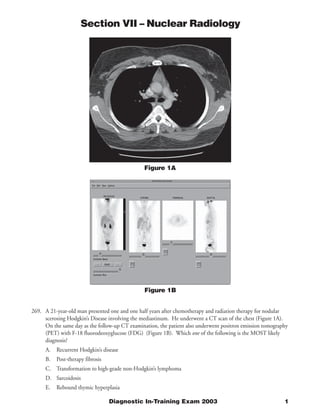 Section VII – Nuclear Radiology




                                               Figure 1A




                                                Figure 1B


269. A 21-year-old man presented one and one half years after chemotherapy and radiation therapy for nodular
     scerosing Hodgkin’s Disease involving the mediastinum. He underwent a CT scan of the chest (Figure 1A).
     On the same day as the follow-up CT examination, the patient also underwent positron emission tomography
     (PET) with F-18 fluorodeoxyglucose (FDG) (Figure 1B). Which one of the following is the MOST likely
     diagnosis?
      A. Recurrent Hodgkin’s disease
      B.   Post-therapy fibrosis
      C. Transformation to high-grade non-Hodgkin’s lymphoma
      D. Sarcoidosis
      E.   Rebound thymic hyperplasia

                                   Diagnostic In-Training Exam 2003                                        1
 