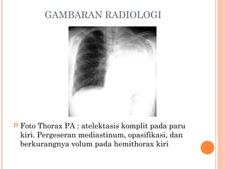 GAMBARAN RADIOLOGI
 Foto Thorax PA : atelektasis komplit pada paru
kiri. Pergeseran mediastinum, opasifikasi, dan
berkurangnya volum pada hemithorax kiri 
 