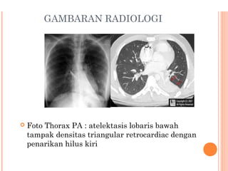 GAMBARAN RADIOLOGI
 Foto Thorax PA : atelektasis lobaris bawah
tampak densitas triangular retrocardiac dengan
penarikan hilus kiri
 